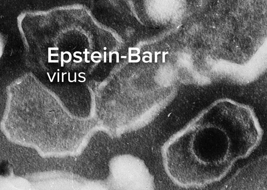 Epstein-Barr virus